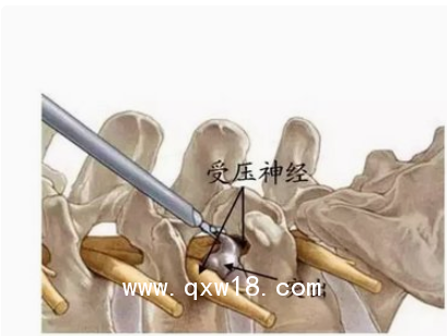 德國ASAP脊柱內窺鏡及手術器械