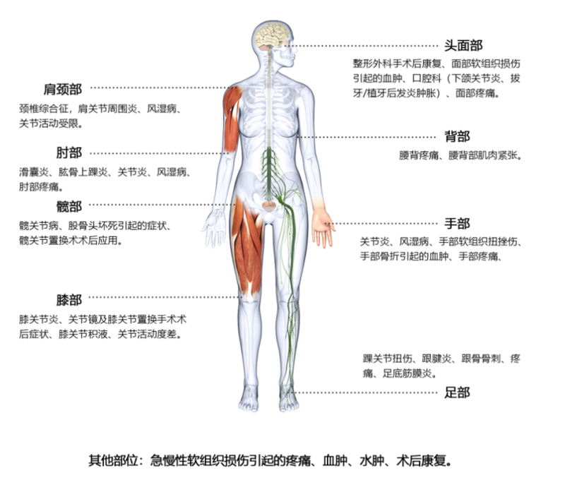 醫(yī)用骨科高壓低溫沖擊鎮(zhèn)痛儀-低溫快速治療康復(fù)設(shè)備