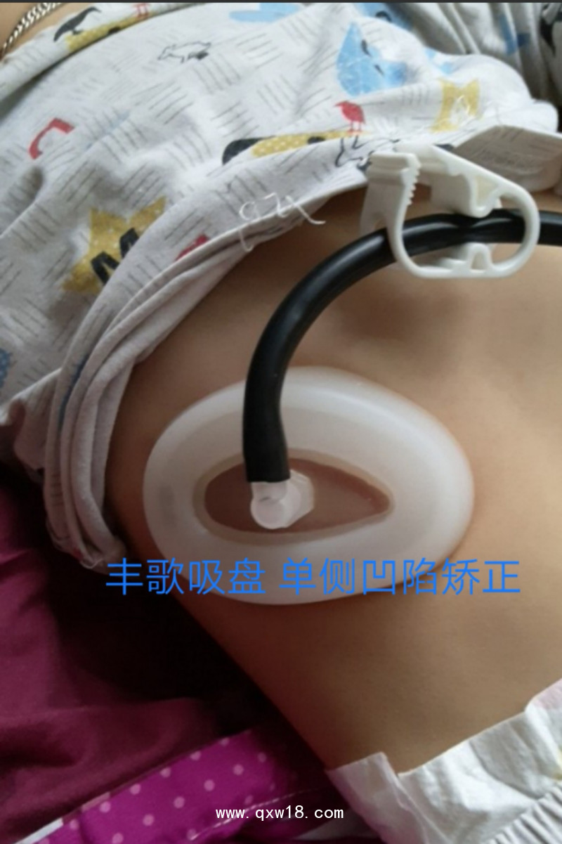 漏斗胸矯正器，負(fù)壓吸盤