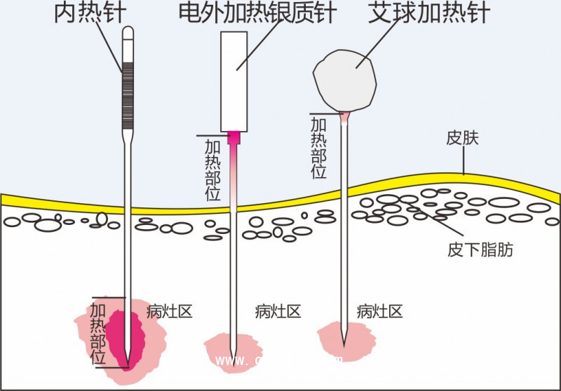 內熱針治療儀針灸針 全國地區(qū)招商