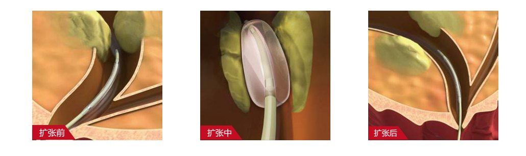 擴(kuò)張球囊.png